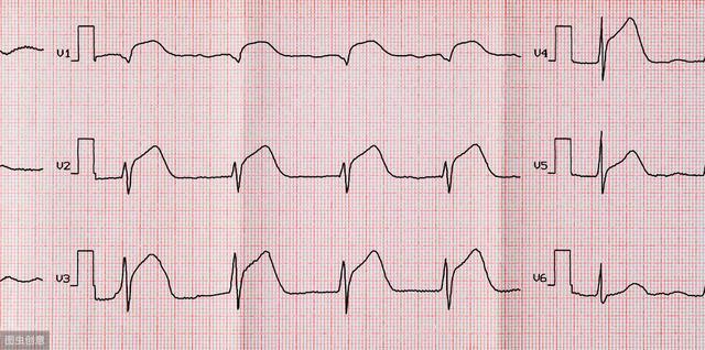一到醫院就做心電圖每次頭提示竇性心律到底是個啥病