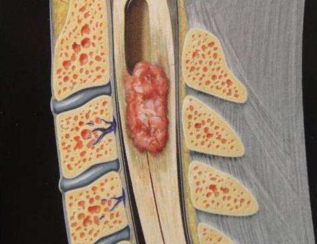 椎管内脂肪瘤图片