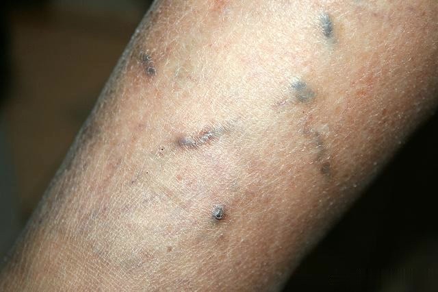 手臂出现血栓会有哪些表现