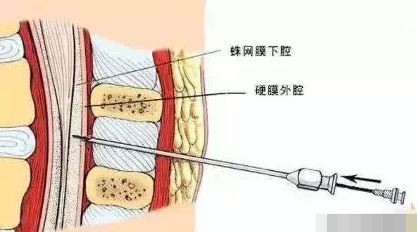 剖腹产之前打麻药疼吗?经历过的妈妈告诉你,看完大开眼界