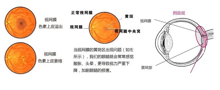 12岁儿童近视100度,医生却说"高度近视",原因真可怕!