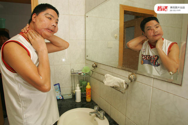 曾被黑熊毁掉面部的云南农民李国兴接受了中国首例,世界上第二例换脸