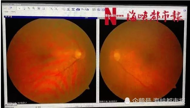 67岁依伯眼睛要失明了？知道真相后，后悔莫及