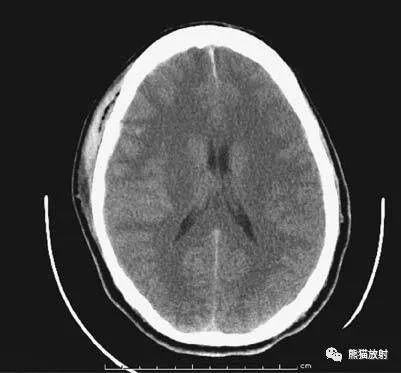 简明又详细的头部ct读片详解 收藏 腾讯新闻