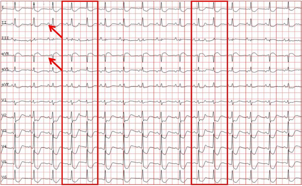 講解洋地黃中毒,這是我見過最有趣的心電圖!