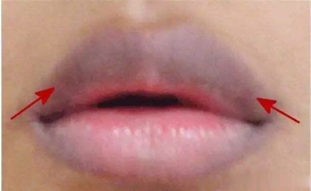 血液粘稠不粘稠 看看嘴就能知道吗 不同颜色对应的症状不同