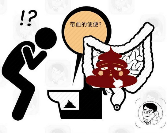 长期慢性腹泻或与便秘交替要当心或许是癌症的表现别再拖