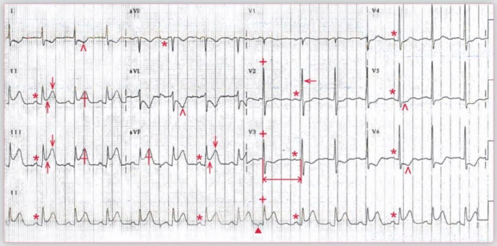 t波對稱,st段抬高,這樣的心電圖如何診斷?