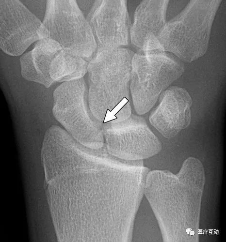 腕关节骨折成像灵敏度对比 Ct Vs X线