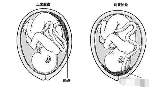 胎盤前置:也叫前置胎盤,是指胎盤位置在子宮的下段,離宮頸口很近,有些