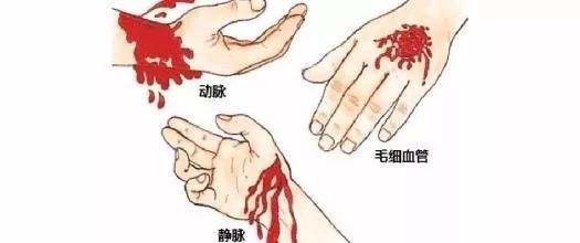 动脉出血怎么止血图片