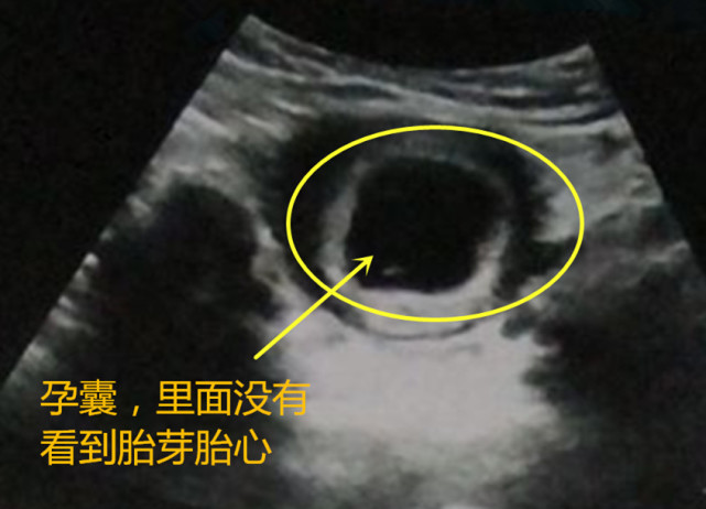 关于孕囊 胎芽 胎心 这些知识你需要了解 胎芽 胚胎 试纸 受孕 停经 胎芽胎心 胚胎停育 周时能 胎心 孕囊