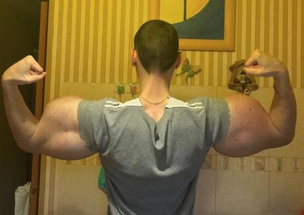 目前俄罗斯巨臂哥的双臂已经成为徒有其表的摆设,这两条大胳膊肿胀