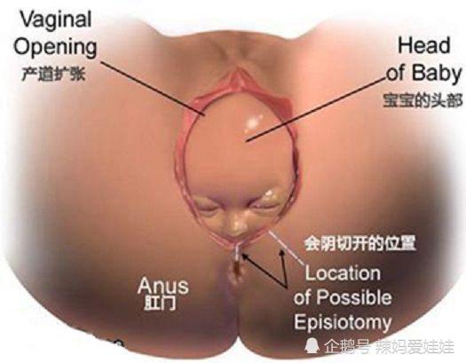 顺产撕裂图片， 生孩子侧切图片真实