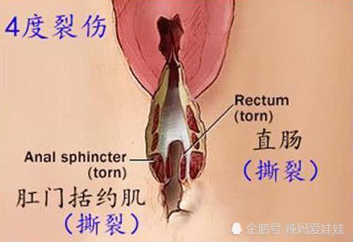 顺产撕裂图片， 生孩子侧切图片真实