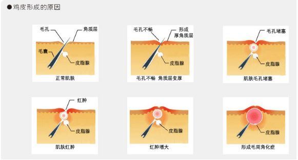 鸡皮肤之王(鸡皮肤产品推荐)