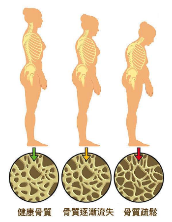 65歲女子骨密度t值37摔倒骨折醫生1物時常吃骨量不會丟