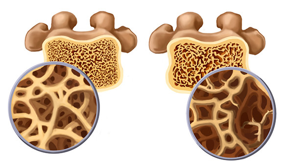 骨科医生告诫:这4件事做不好,骨质疏松很难远离