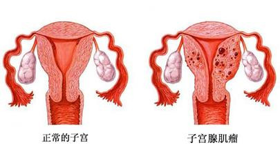 子宫腺肌症平时注意什么运动呢 孙爱达专家为您解答