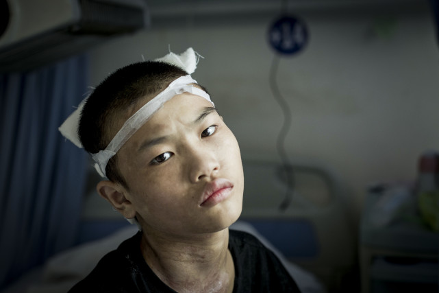 痛心,贵州雪地流浪男孩再遭厄运 被高压电击伤导致截肢