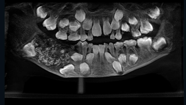 7岁男孩下巴疼去看病 医生从他嘴里拔出526颗牙 下巴 拉曼尼 牙齿