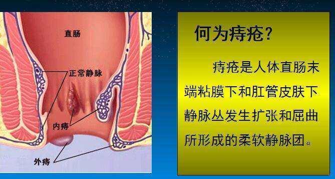 痔疮可以自愈吗 有哪些治疗手段 医生告诉你答案