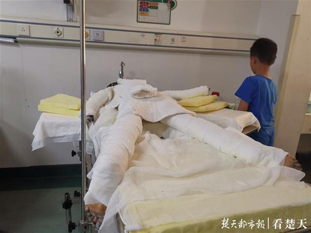 的小女孩婷婷(化名),浑身缠着纱布趴在武汉第三医院烧伤病区的病床上