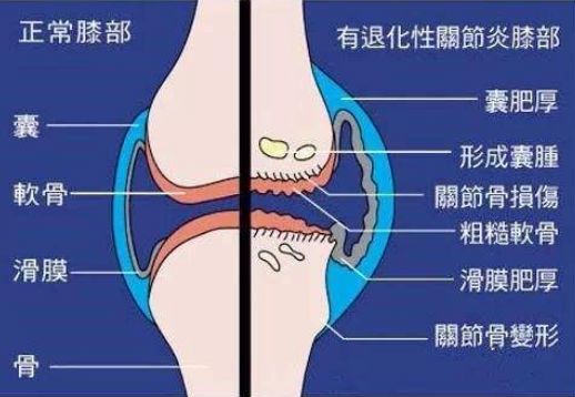 膝盖有一万种疼法 骨科专家教你鉴别损伤在哪