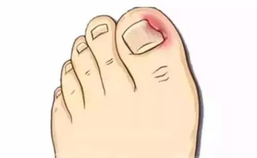 大家知道甲沟炎的初期状况吗?