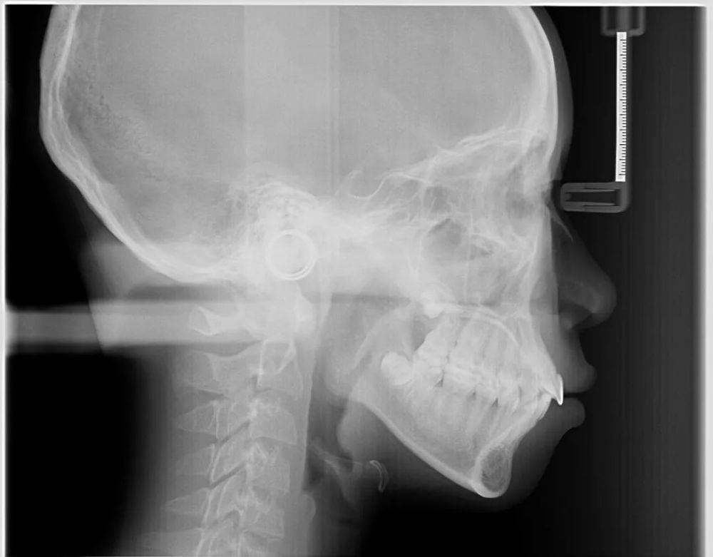 只是给孩子矫正牙齿为什么还要拍x光和ct