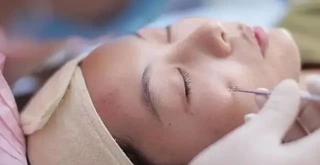 挤黑头一时爽,挤完肌肤"火葬场"!