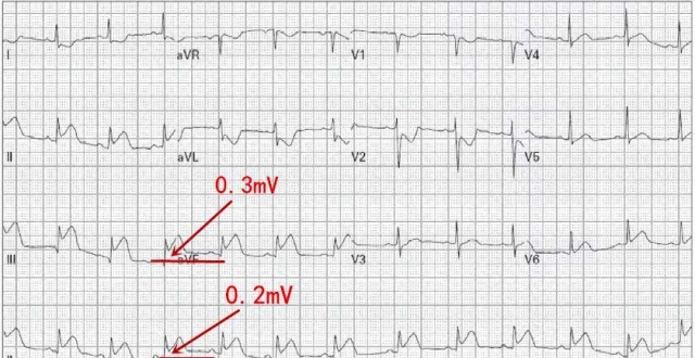 电图连载11"景永明:特殊病例的散点图分析常规12导联诊断右室心肌梗死