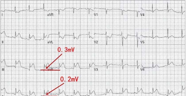 右室心肌梗死心电图图片