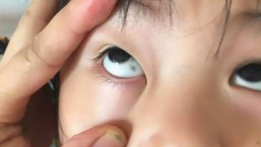 孩子眼白上有"黑点"?大多有3个原因,早知道早预防