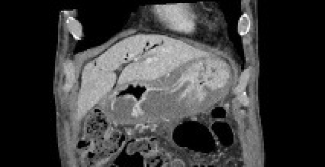 一文读懂急性胃痛 CT 检查表现_腾讯新闻