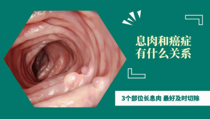 息肉竟是癌症的"祸根"!提醒:3个部位长息肉,最好及时切除