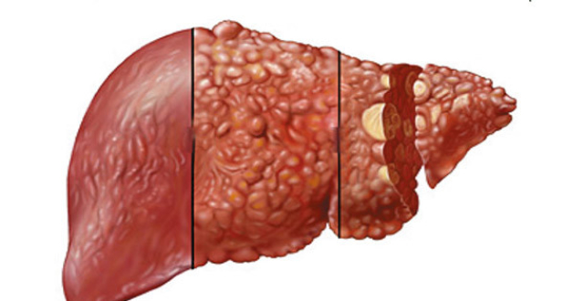 原发性肝癌的临床表现