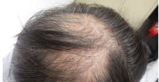 缺铁性贫血会引起脱发