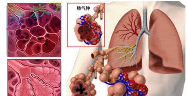 治疗肺气肿的最佳药物什么情况下肺炎才打激素肺心病氧疗指标感冒不