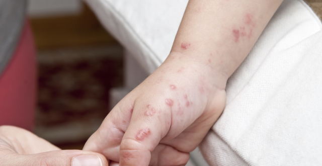 三期梅毒有哪些症状表现呢,你们知道吗?