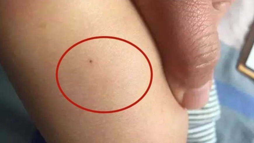 呼和浩特一幼儿园多名孩子身上现针眼,警方通报来了!