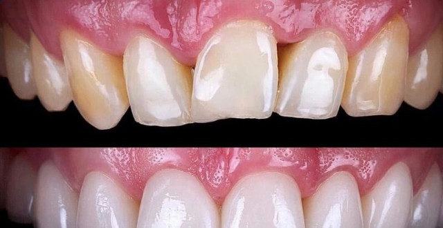 牙齿变黄,颜色不好看,难道就一直这样下去吗!