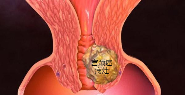 做到以下三点,让女人一生远离宫颈癌!