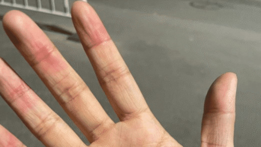 手流血 腾讯网