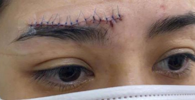 阿娇亲自晒伤口照,缝针的线是蓝色的呈t型,素颜皮肤暗淡无光