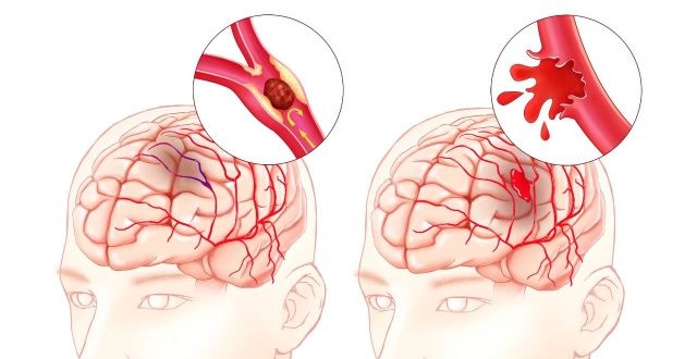 乌克兰干细胞治疗脑卒中(中风)和创伤性脑损伤及并发症
