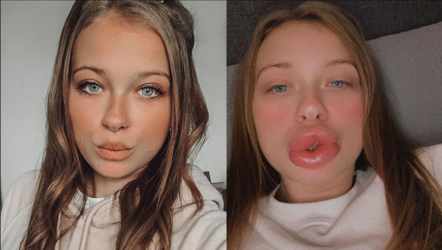 英国美女贪小便宜,廉价整容变毁容,嘴巴肿成香肠,美貌难再回!