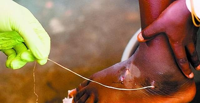 让350万人痛苦不堪的寄生虫:长达1.2米,钻进人体内产卵!