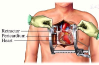 疑似艾滋病感染的黄金自救时间:72小时