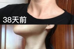 经常看到有说瘦脸，瘦腿，瘦腰的，如果脖子粗，怎么瘦脖子？